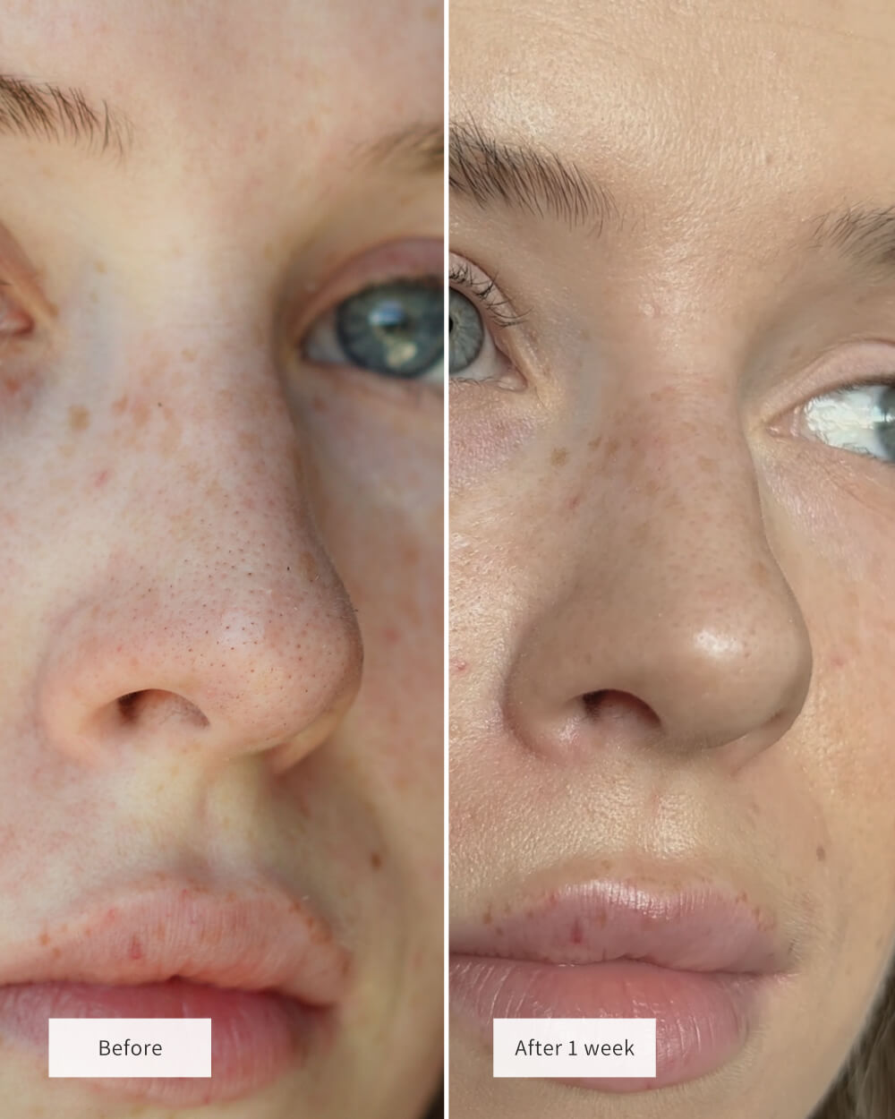 Nose Patches